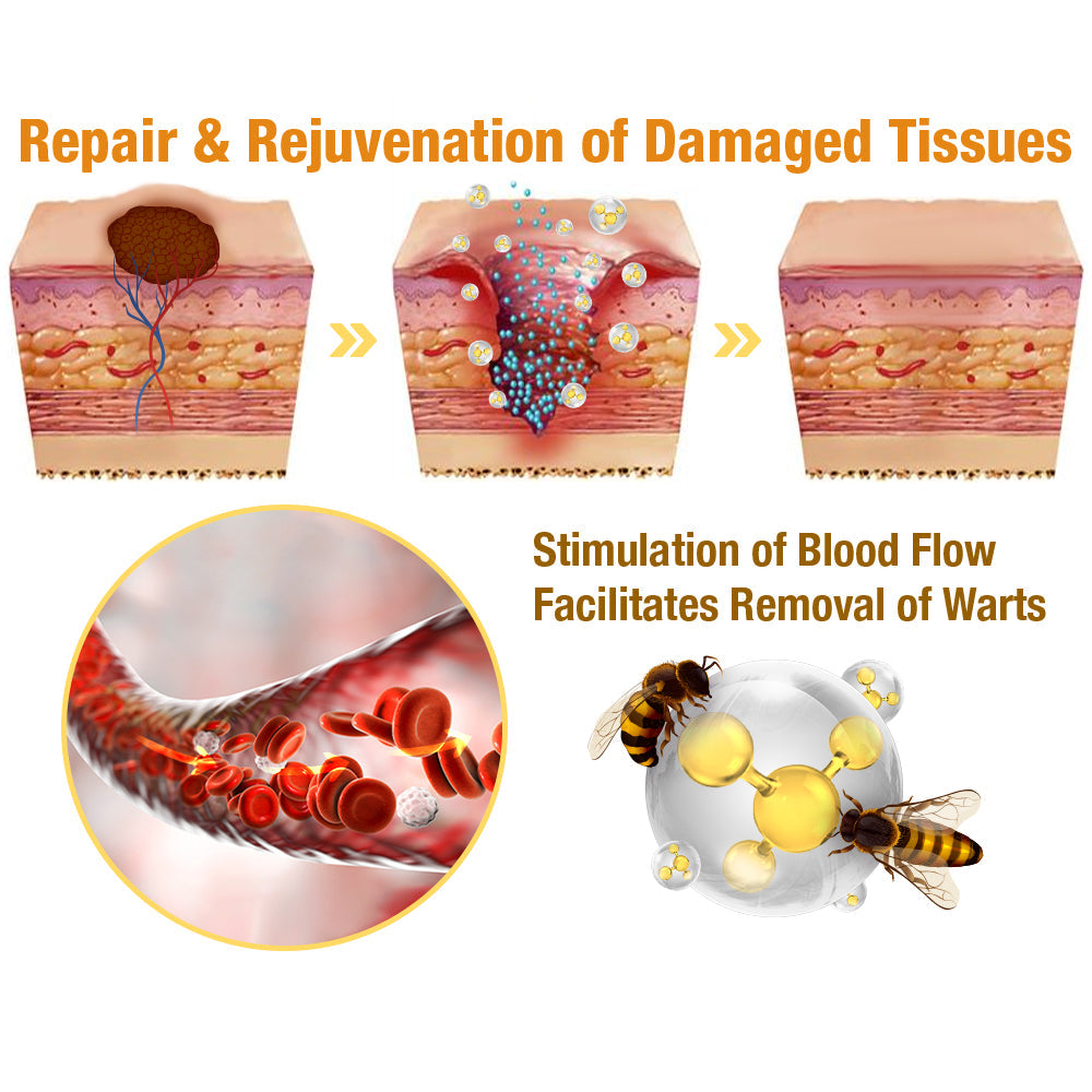 Flysmus™ Skin Tag Bee Venom Remover